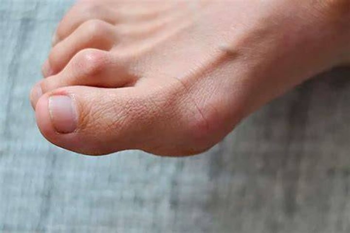 Why is my big toe cuticle swollen?