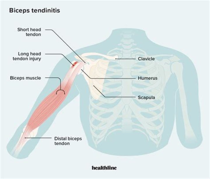 Why is my pectineus sore?