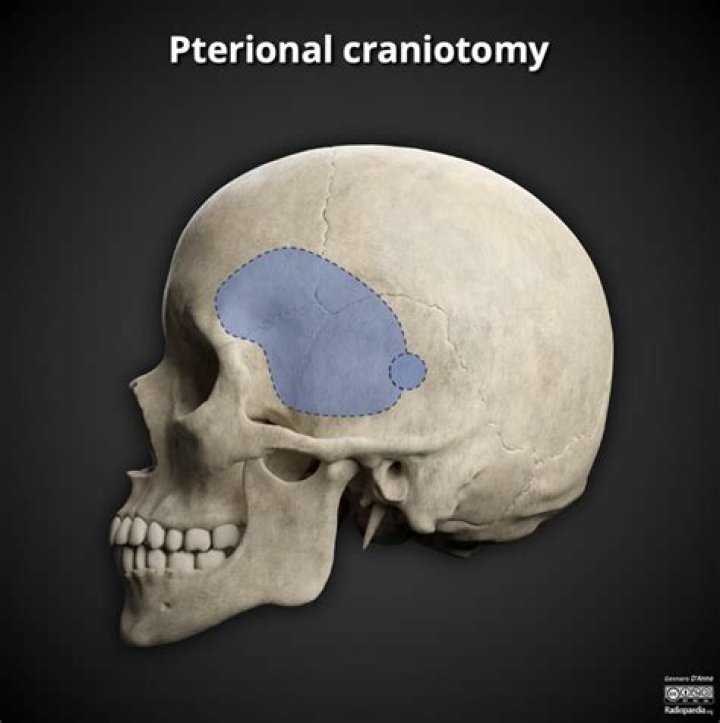 Why is the pterion clinically important?