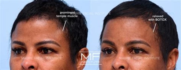Why use filler in temples?