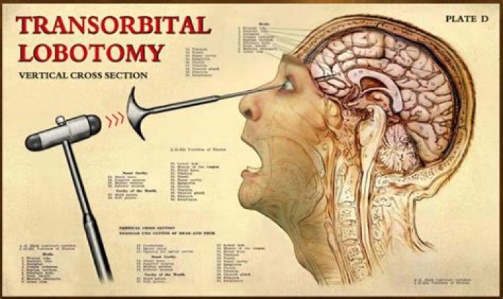 Why was lobotomy used?