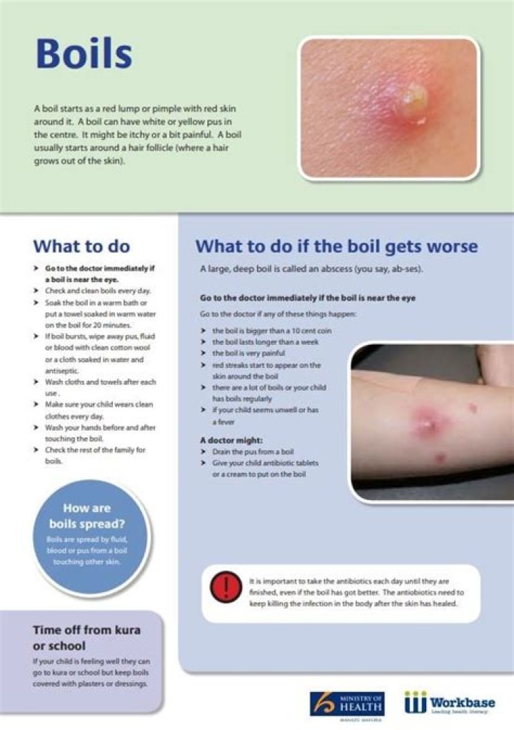 Why won't my boils go away?