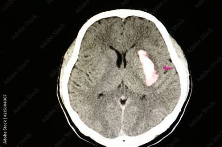 Will a ct scan show a blood clot in the brain?