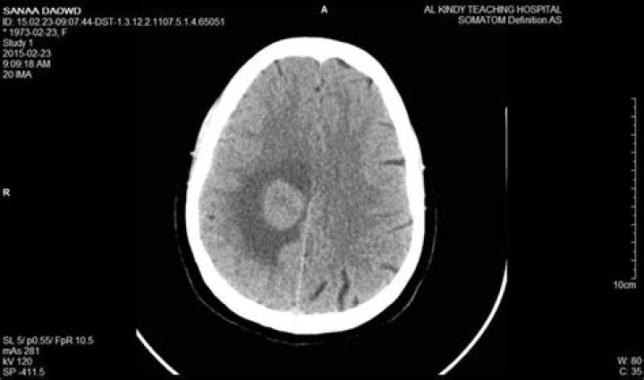 Will a ct scan show a brain tumor?