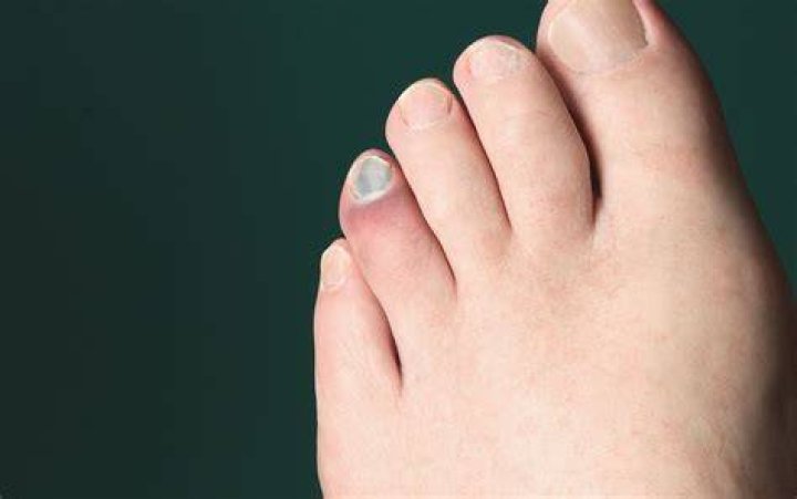 Will a stubbed toe heal on its own?