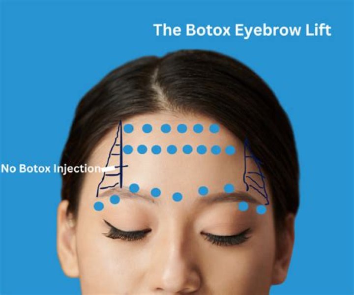 Will botox make my eyes droop?