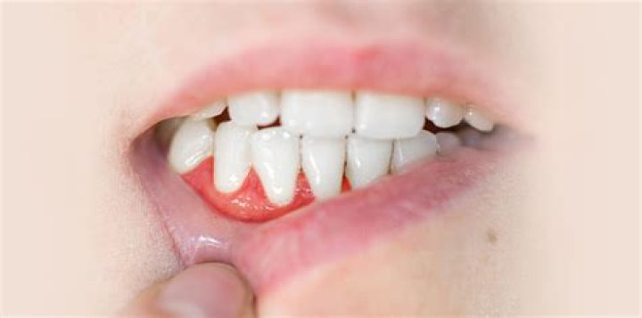 Will flossing help swollen gums?