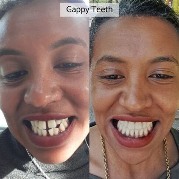 Will gaps in teeth close?