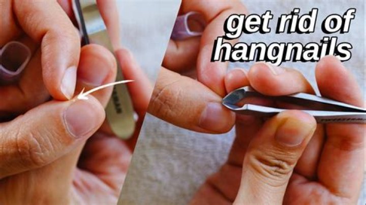 Will hangnails go away on their own?