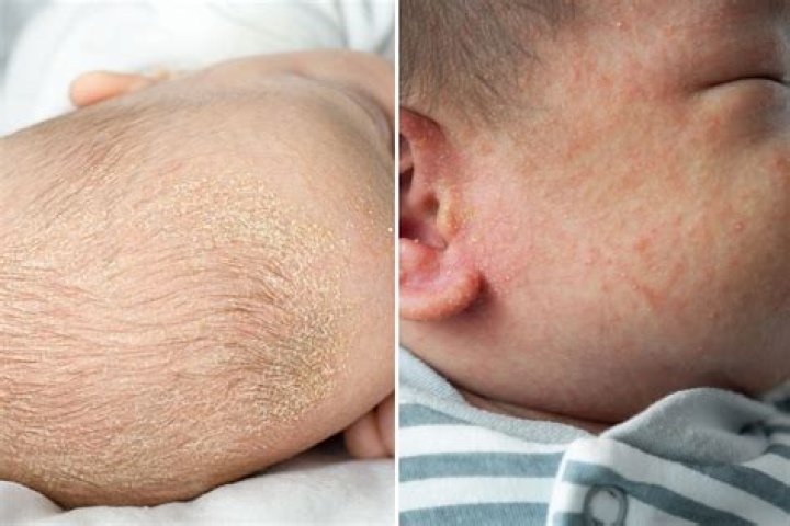 Will infantile eczema go away?