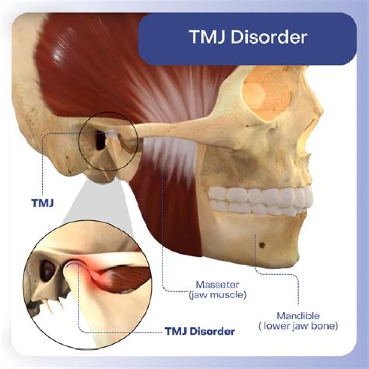 Will jaw surgery fix tmj?