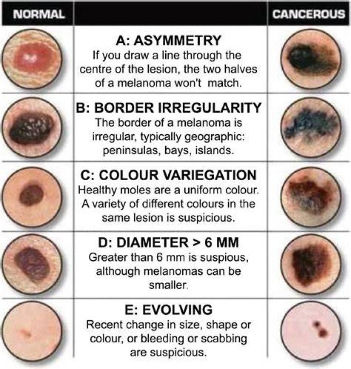 Will nodular melanoma bleed?