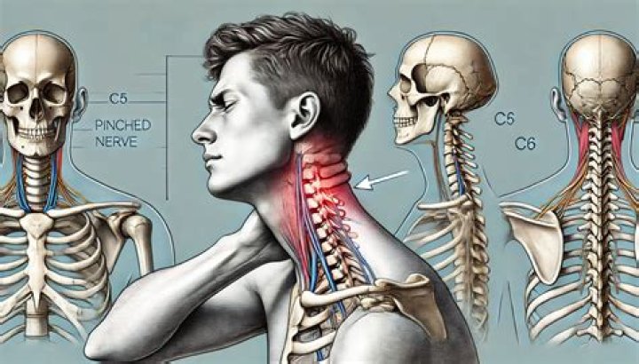 Will pinched nerve go away?