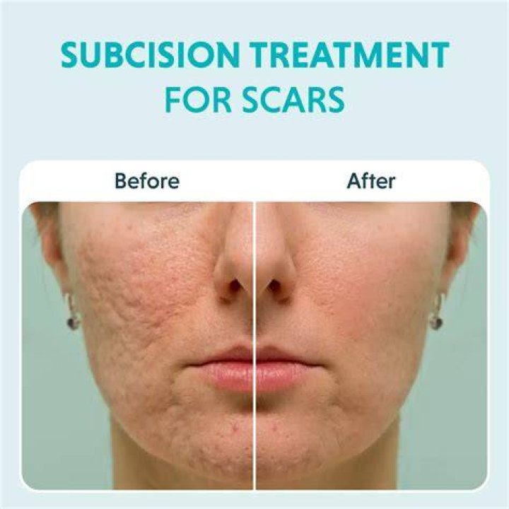 Will saliva remove acne?