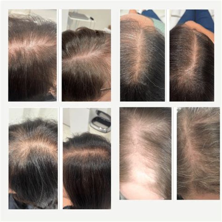 Will selenium help with hair loss?