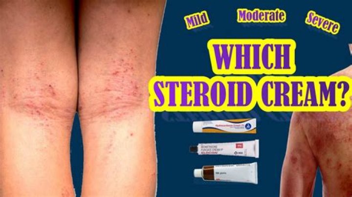 Will steroid cream help urticaria?