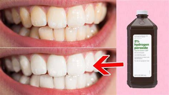 Will swishing with hydrogen peroxide whiten teeth?