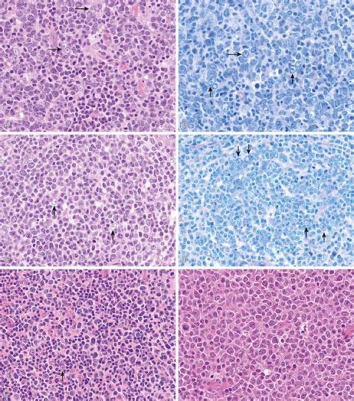 Will there ever be a cure for follicular lymphoma?