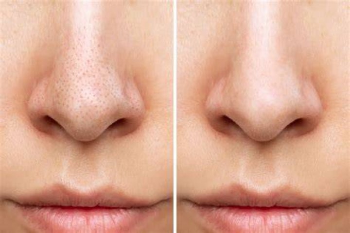 Would a facial get rid of blackheads?