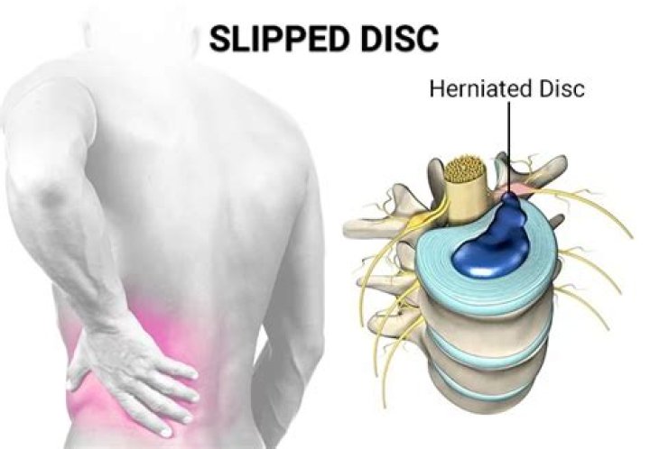Would a slipped disc hurt to touch?