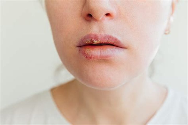 Would guys date a girl with herpes?
